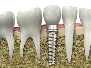 implant tedavisi